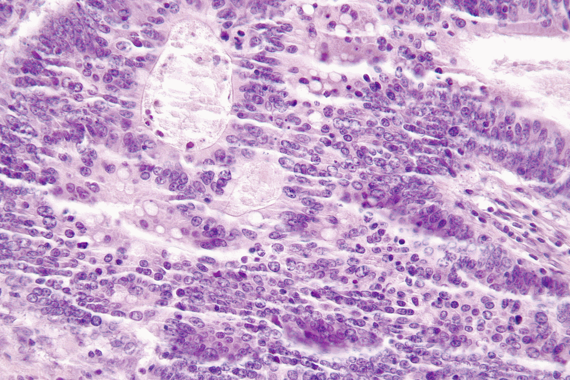 Very high magnification micrograph of tumor infiltrating lymphocytes, abbreviated TILs, in a case of colorectal carcinoma. TILs may also be spelled tumour infiltrating lymphocytes.